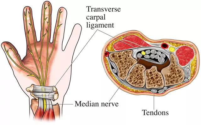 Carpal Tunnel Conditions Treatment Diagram Chiropractor Fairhaven, MA